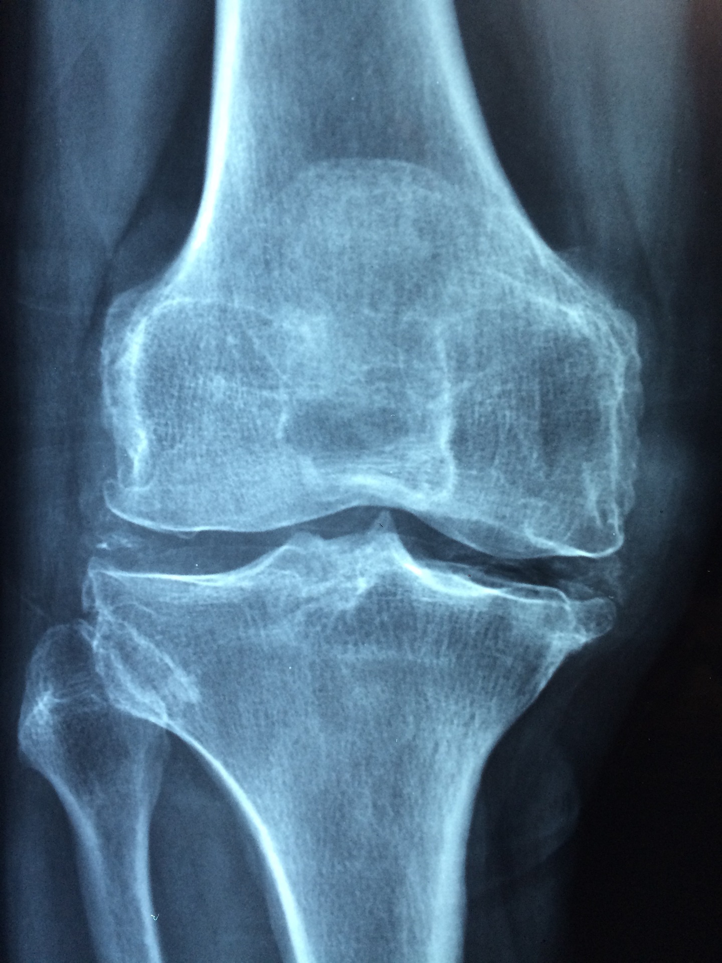 X-ray of a knee joint